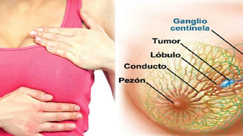 Diagrama de seno con tumor.png